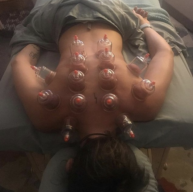 What is cupping?  Should I try it?